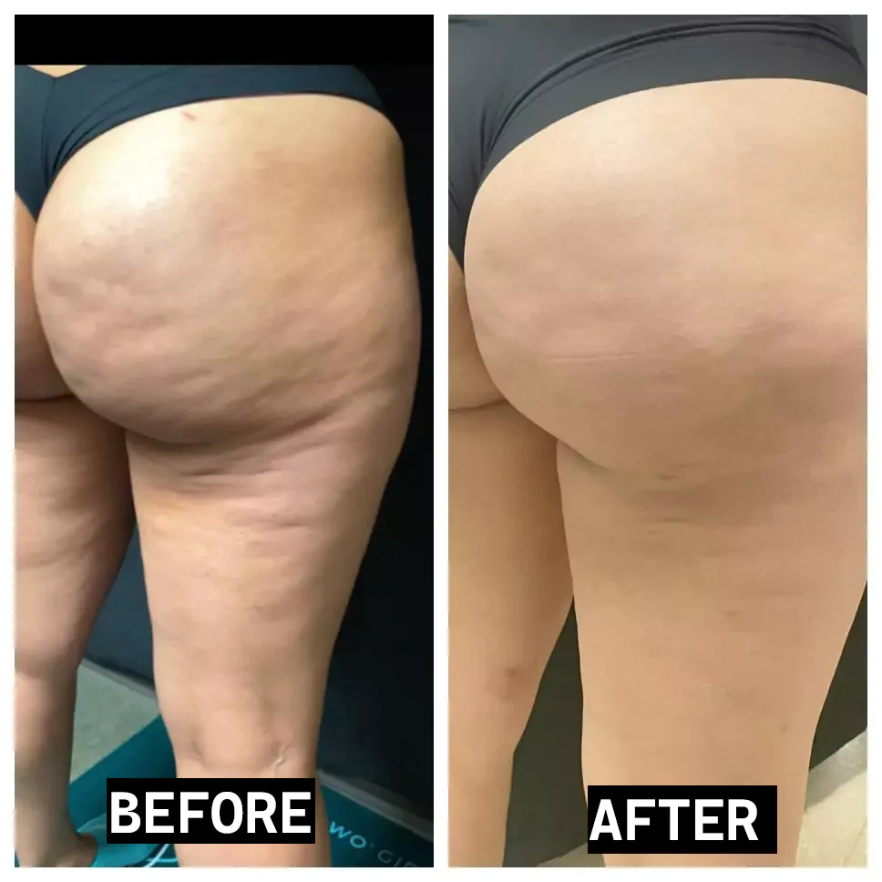 Anti-Cellulite Cream - Image 5